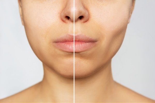 A buccal fat removal segítségével élesíthetők az arc kontúrjai.